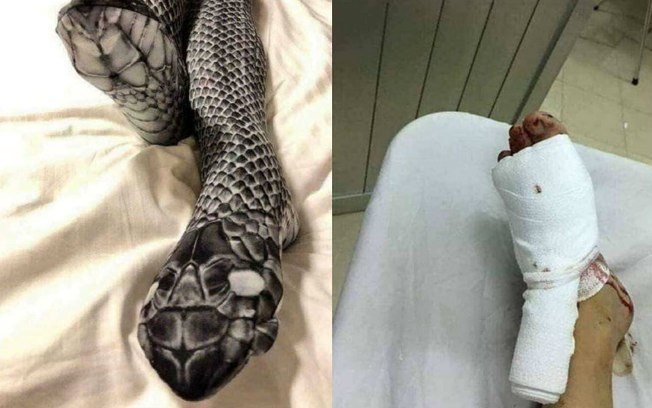 Homem confunde meia-calça com cobra e deixa mulher ferida