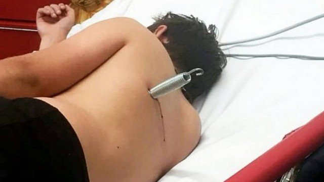 Defeito em cama elástica deixa jovem com mola cravada nas costas