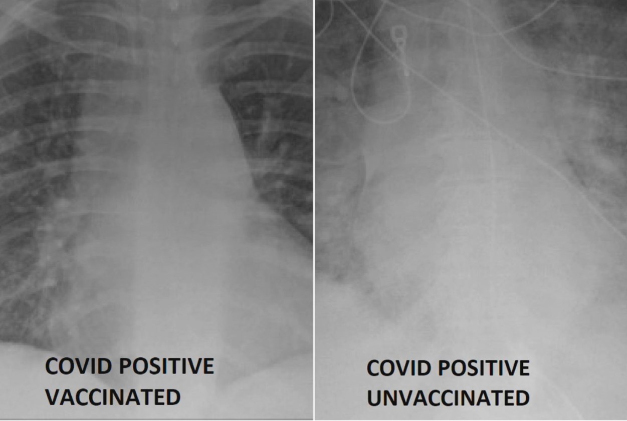 Exames mostram pulmões de pacientes vacinados e não vacinados contra a Covid-19