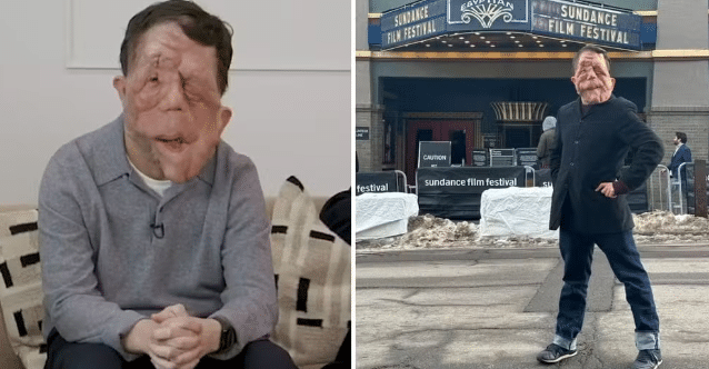 Ator Adam Pearson, de 39 anos, revela como enfrenta o preconceito por doença na face