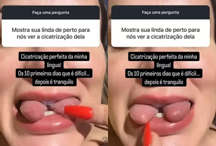 Andressa Urach mostra resultado final de bifurcação de língua